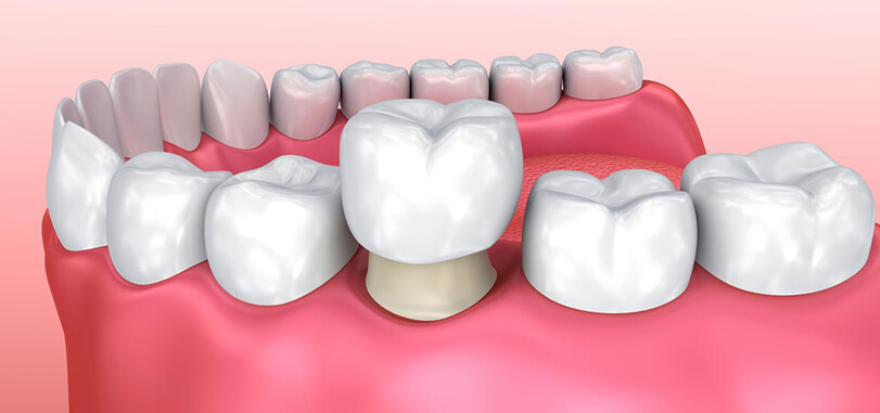 Zahnkronen und Zahnbrücken 1