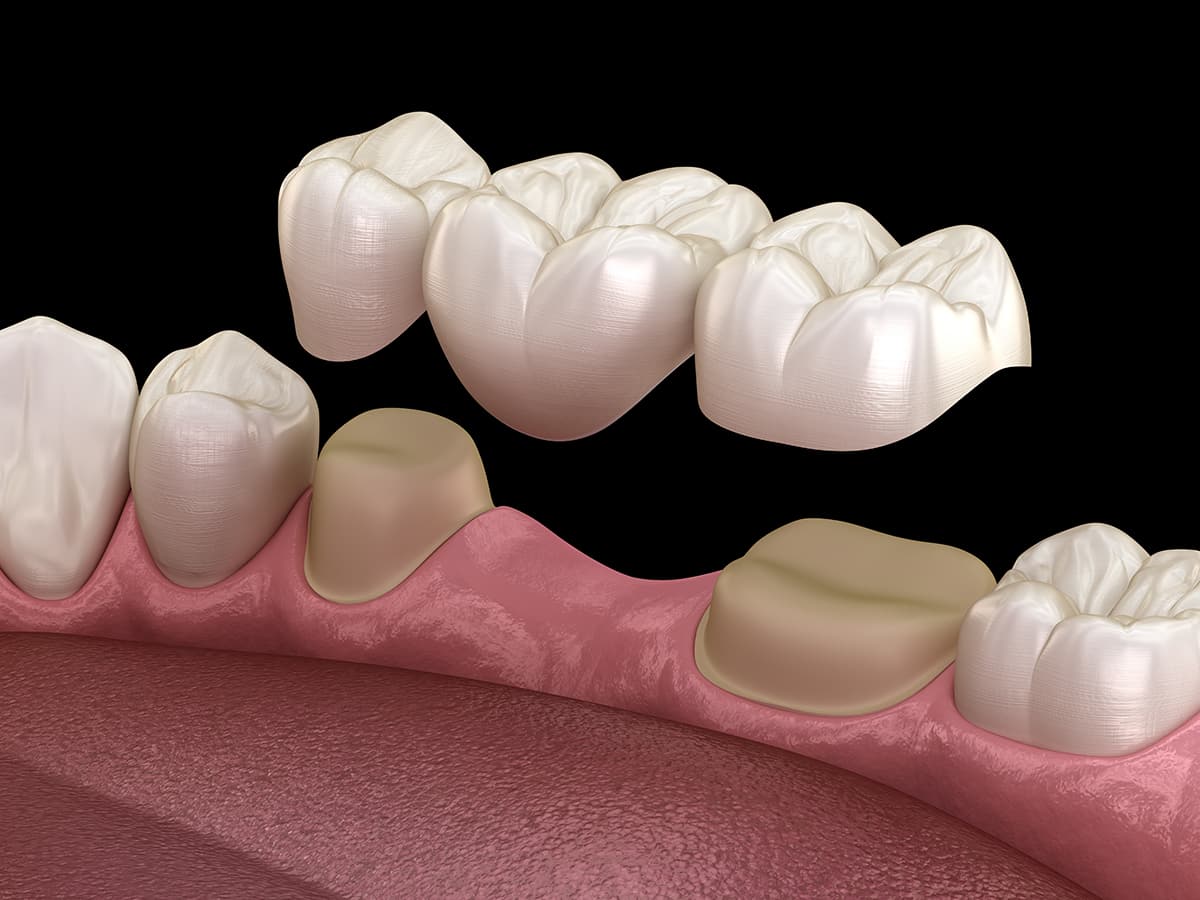 Zahnkronen und Zahnbrücken 2