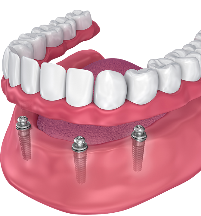 Zahnprothese und Teilprothese 3